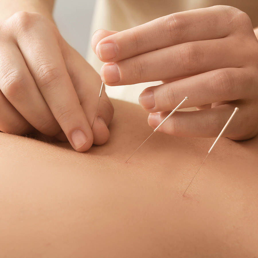 ACUPUNCTURE