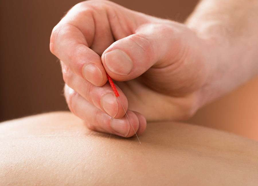 acupuncture back pain